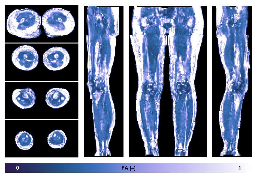 IVIM corrected whole leg muscle fractional anisotropy obtained from diffusion tensor imaging.